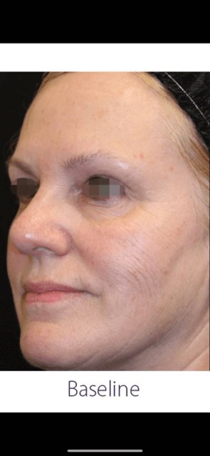 OPUS/CLEARLIFT TREATMENT