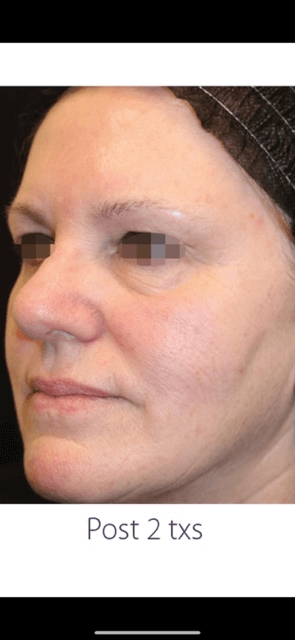 OPUS/CLEARLIFT TREATMENT