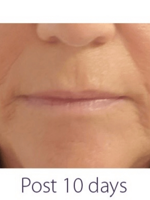 OPUS/CLEARLIFT TREATMENT