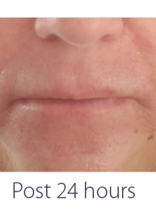 OPUS/CLEARLIFT TREATMENT