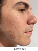 OPUS-ACNE SCARRING